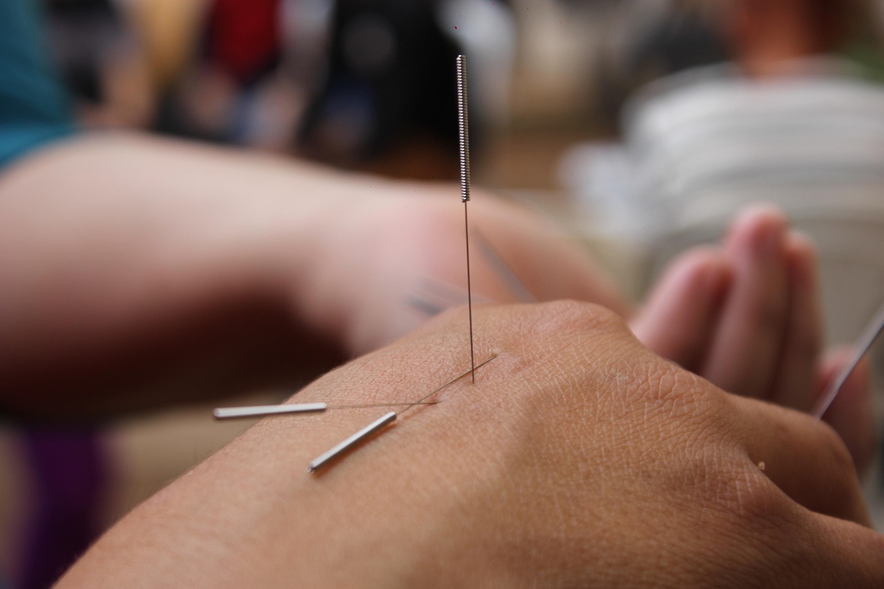 acupuncture richmond hill toronto markham therapy wellness di trani